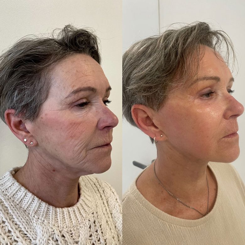 avant-apres-lasser-CO2-visage-entier