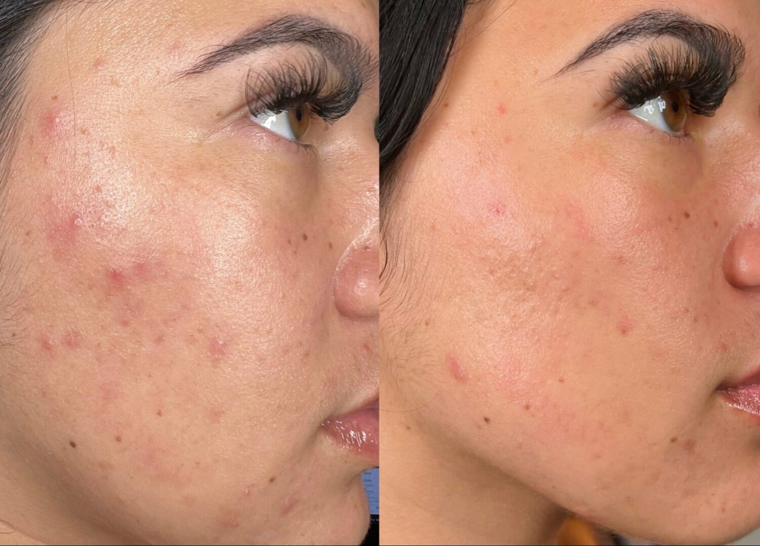 Hydrafacial lhoest clinic avant après