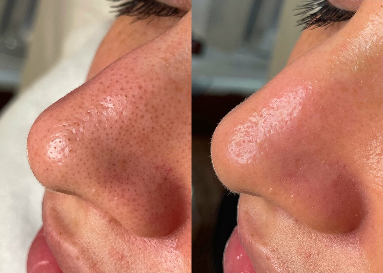 Hydrafacial lhoest clinic avant après