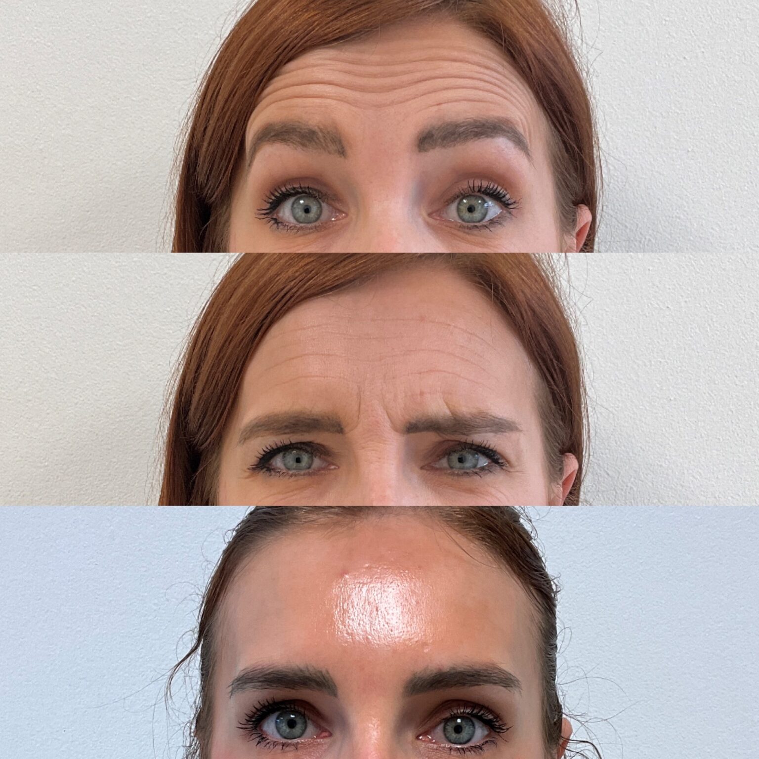 Avant apres botox Lhoest clinic Lille
